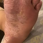 Eczema highlight